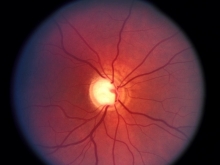 Атрофия зрительного нерва - симптомы, классификация, причины патологии, диагностика и лечение атрофии зрите