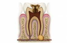 Удаление кисты без удаления зуба: подробности процедуры