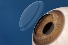 Пересадка роговицы глаз: описание, показания, стоимость, отзывы. Микрохирургия глаза
