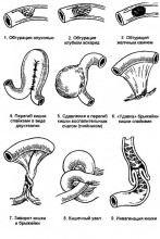 Кишечная непроходимость либо заворот кишок