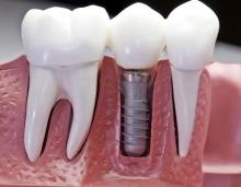 Имплантация зубов вернет былую уверенность