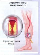 Атеросклероз сосудов нижних конечностей