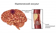 Ишемический инсульт - симптомы, виды и лечение заболевания