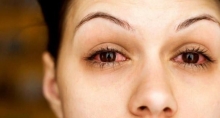 Епісклерит глаза: признаки, причины, лечение