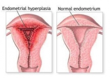 Выскабливание при гиперплазии эндометрия: особенности, показания и последствия