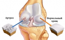 Как и где лечить артроз суставов?