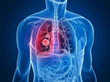 Народные методы лечения злокачественных опухолей легких