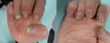 Кандидоз ногтей: симптомы, лечение