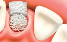 Костная пластика при имплантации зубов: отзывы