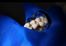 Коффердам - это Применение коффердама в стоматологии