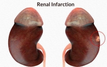 Инфаркт почки: причины, симптомы и лечение