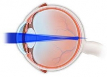 Сложный миопический астигматизм обоих глаз у детей: лечение