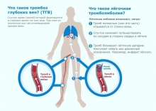 Народные методы лечения тромбоза глубоких вен