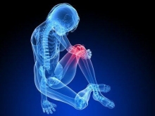 Пателлофеморальный артроз коленного сустава: особенности болезни и лечение