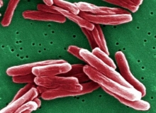 Диссеминированный туберкулез легких: симптомы и лечение