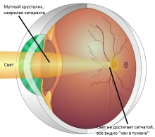 Катаракта - симптомы и лечение