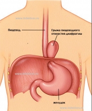 Грыжа пищевода