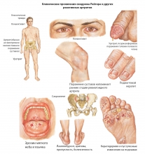 Реактивный и ревматоидный артрит у детей: симптомы и лечение