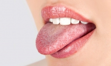 Болезнь и воспаление языка – лечение глоссита - лечение, глоссит, воспаление языка, лечение