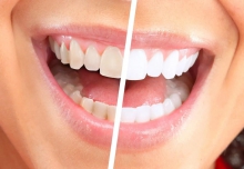 Действенные методы отбеливания зубов в домашних условиях - гигиена и эстетика, отбеливание зубов, домашние условия, методы