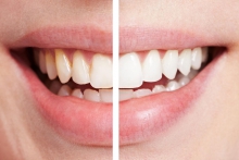 Для чего нужно отбеливать зубы? - гигиена и эстетика, белоснежная улыбка, отбеливание зубов, комплексы