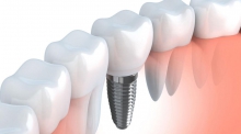 Имплантация зубов: за и против - протезы и импланты, имплантат, имплантация, недостатки, преимущества, протезирование