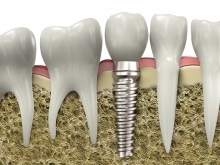 Имплантация зубов за один визит – это реально - протезы и импланты, общий наркоз, имплантация