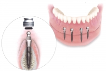Крепление зубного протеза – внутрішньослизові вставки - протезы и импланты, внутрішньослизові вставки, зубной протез, крепление