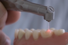 Лечение зубов лазером - лечение, лазерная стоматология, лечение