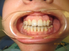 Макродентия - лечение, аномалия размера, аномалия формы зубной ряд, лечение, макродентия