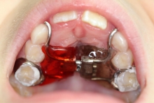 Методы ортодонтического лечения – брекет-система, съемные пластины - гигиена и эстетика, брекет-системы, брекеты, ортодонтическое лечение, пластины