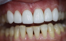Наращивание зубов - гигиена и эстетика, восстановление, геліокомпозит, наращивание зубов