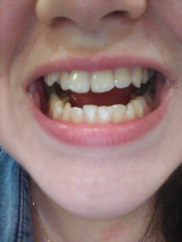 Оголяются зубы: почему это произошло со мной и как поступить? - лечение, лечение, обнажение зуба, причины