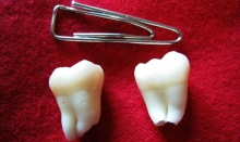 Перикоронарит: лечение и кариес зуба мудрости - лечение, зуб мудрости, кариес, перикоронарит, перикоронит