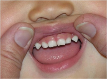 Почему стираются зубы: причины, профилактика и лечение - гигиена и эстетика, лечение, причины истиранию, профилактика, стирание зубов
