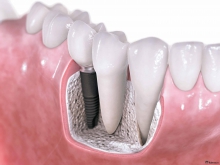 Протезирование зубов из металлокерамики: от “родных” не отличишь - протезы и импланты, метелокераміка, протезирование зубов