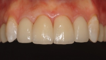 Протезирование зубов керамическими винирами - протезы и импланты, керамические виниры, протезирование зубов