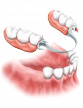 Съемное протезирование зубов - протезы и импланты, бюгельный протез, съемное протезирование