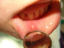 Стоматит: симптомы – язвы в полости рта, на языке - лечение язвы, симптомы, стоматит