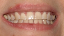 Тетрациклиновые зубы - лечение, лечение, тетрациклин, тетрациклиновые зубы, окрашивание зубов