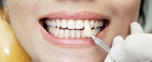 Виниры – это эстетическая облицовка зубов - гигиена и эстетика, виниры, эстетическая стоматология, противопоказания