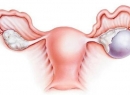 Киста яичников: размеры для операции опасные и нормальные