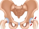 Тазобедренный сустав: перелом и его последствия. Эндопротезирование тазобедренного сустава, реабилитация после операции