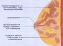 Мастит - симптомы воспалительного процесса молочной железы, причины груднице, виды, лечение