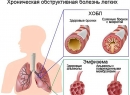 Народные методы лечения хронической обструктивной болезни легких