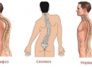 Кифосколиоз грудного отдела позвоночника: виды и лечение