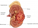 Рак почки Симптомы и причины болезни