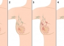 Рак молочной железы - симптомы