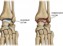 Диагностирование и методы лечения артроза голеностопного сустава