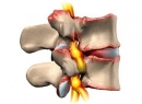 Хондроз поясничного отдела позвоночника: симптомы, лечение, причины и диагностика